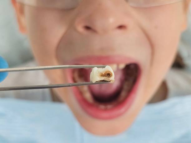 Best Emergency Tooth Extraction in Butler, WI